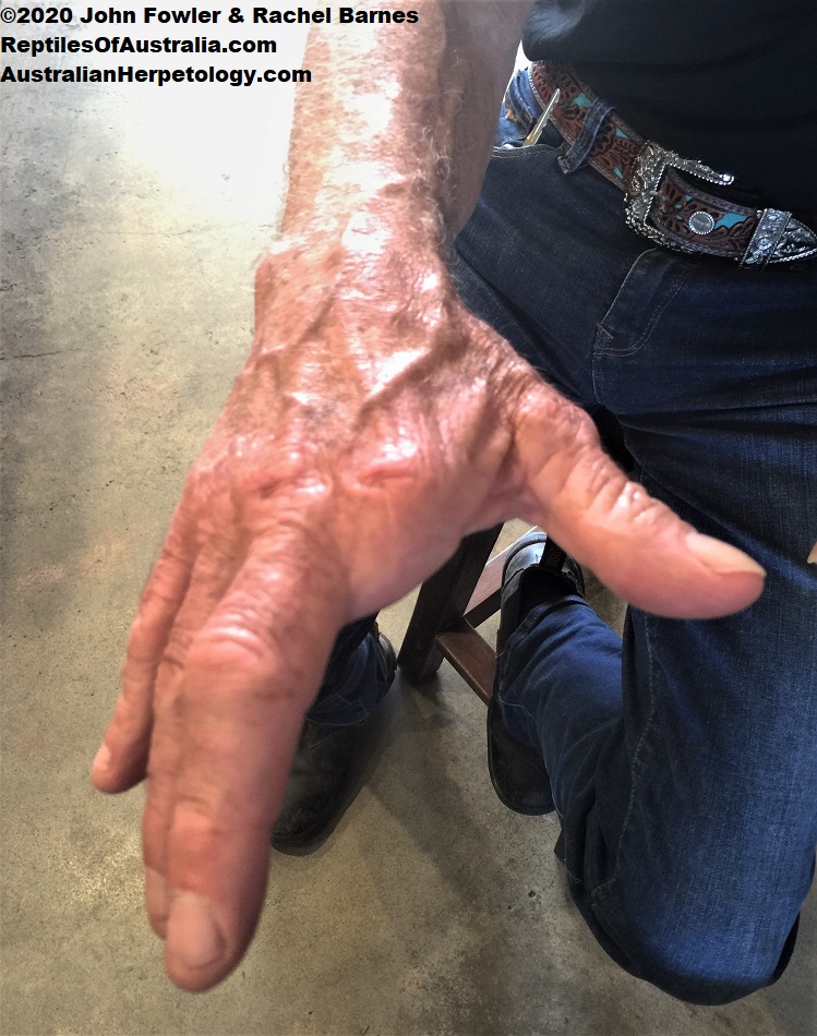Photo of Neville Burns hand missing the bitten finger taken in 2017